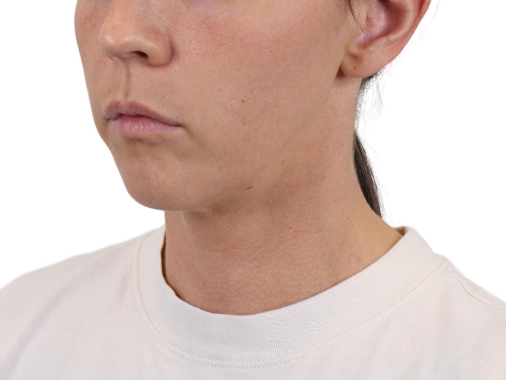 Deep Neck Lift Before & After Gallery - Patient 146130015 - Image 3