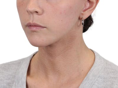 Deep Neck Lift Before & After Gallery - Patient 146130015 - Image 4