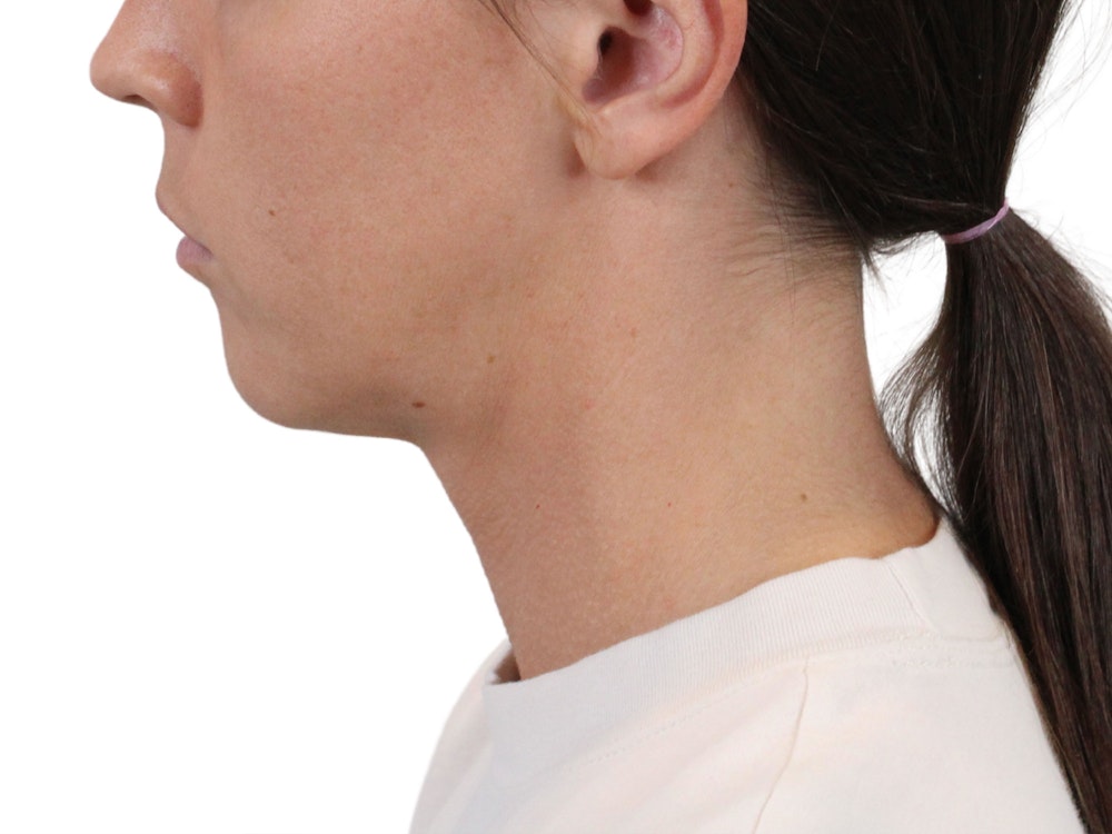 Deep Neck Lift Before & After Gallery - Patient 146130015 - Image 5