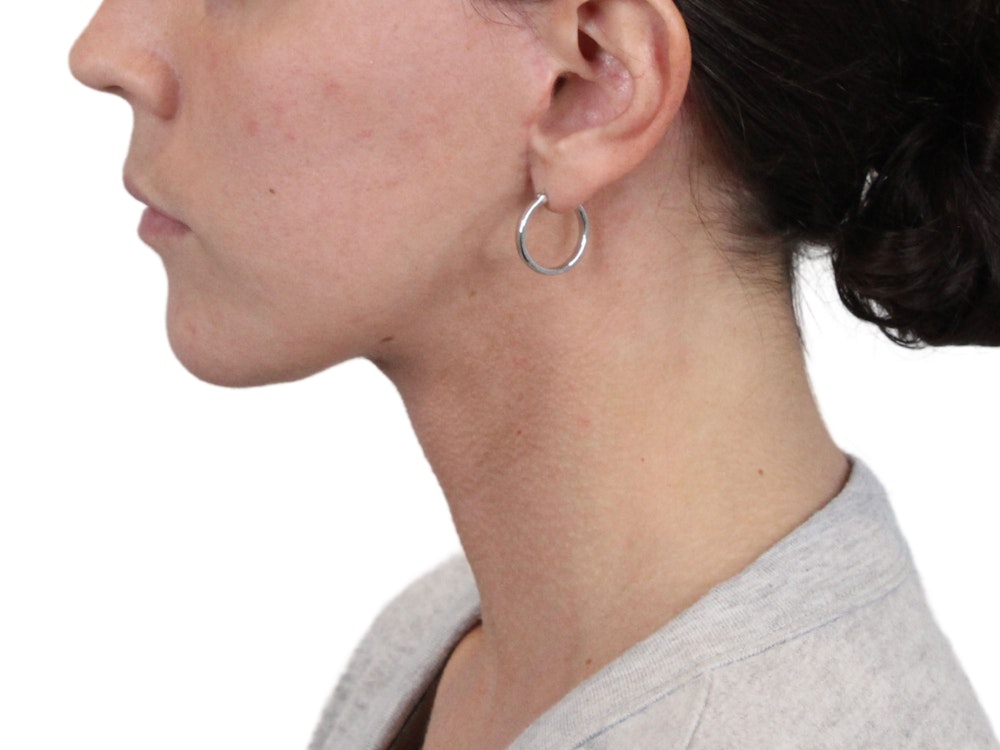 Deep Neck Lift Before & After Gallery - Patient 146130015 - Image 6