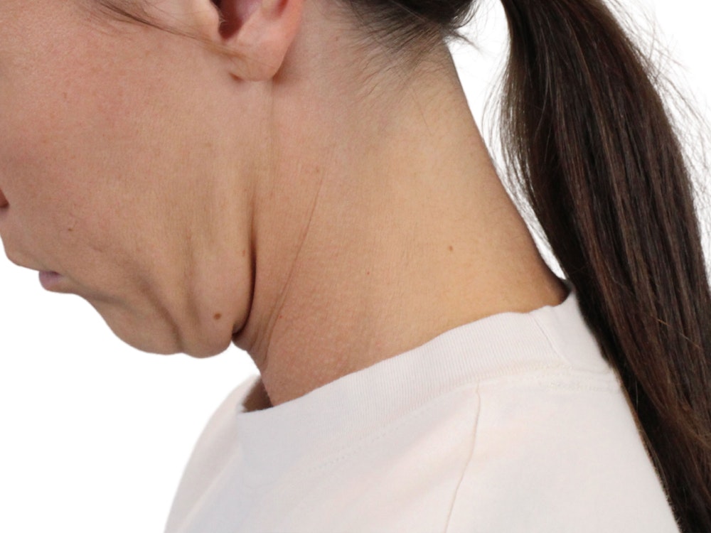 Deep Neck Lift Before & After Gallery - Patient 146130015 - Image 7