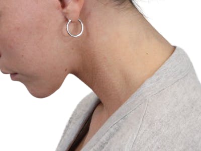 Deep Neck Lift Before & After Gallery - Patient 146130015 - Image 8