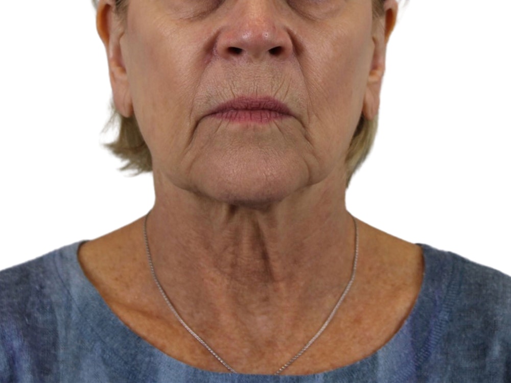 Deep Neck Lift Before & After Gallery - Patient 118972217 - Image 1