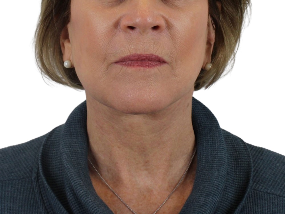 Deep Neck Lift Before & After Gallery - Patient 118972217 - Image 2
