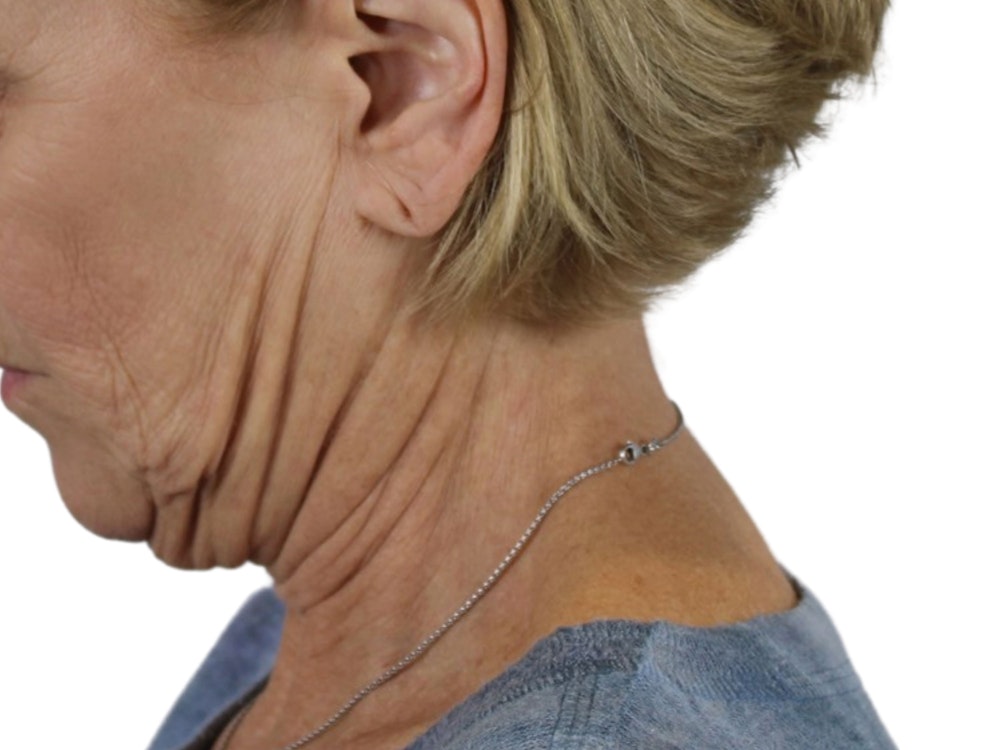 Deep Neck Lift Before & After Gallery - Patient 118972217 - Image 3