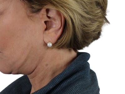 Deep Neck Lift Before & After Gallery - Patient 118972217 - Image 4