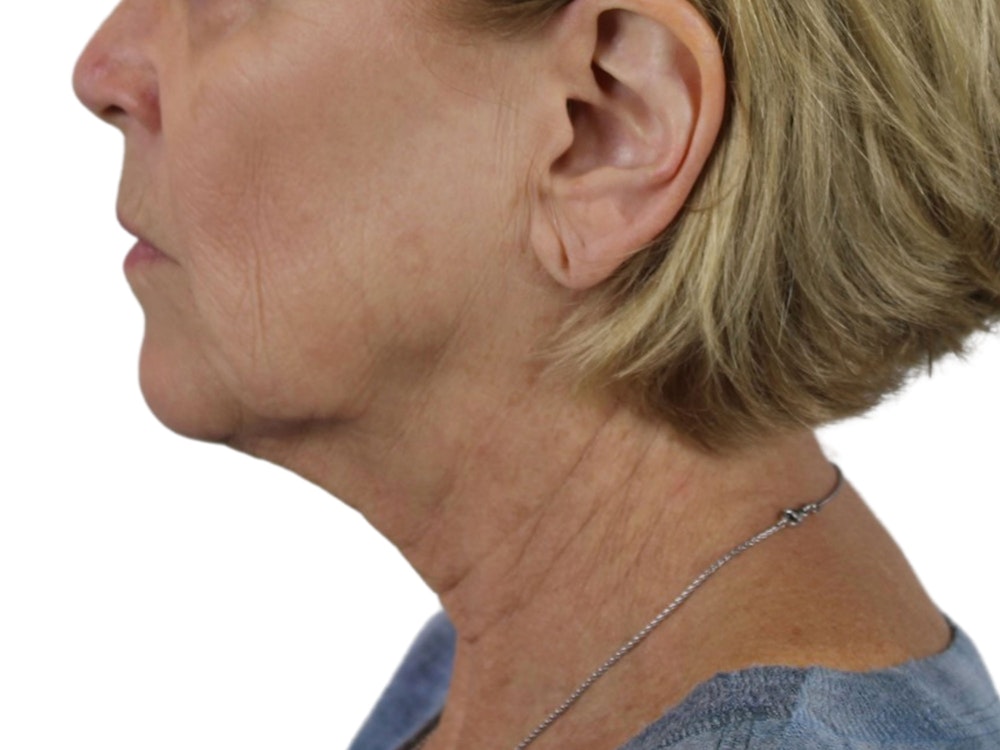 Deep Neck Lift Before & After Gallery - Patient 118972217 - Image 5