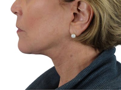 Deep Neck Lift Before & After Gallery - Patient 118972217 - Image 6