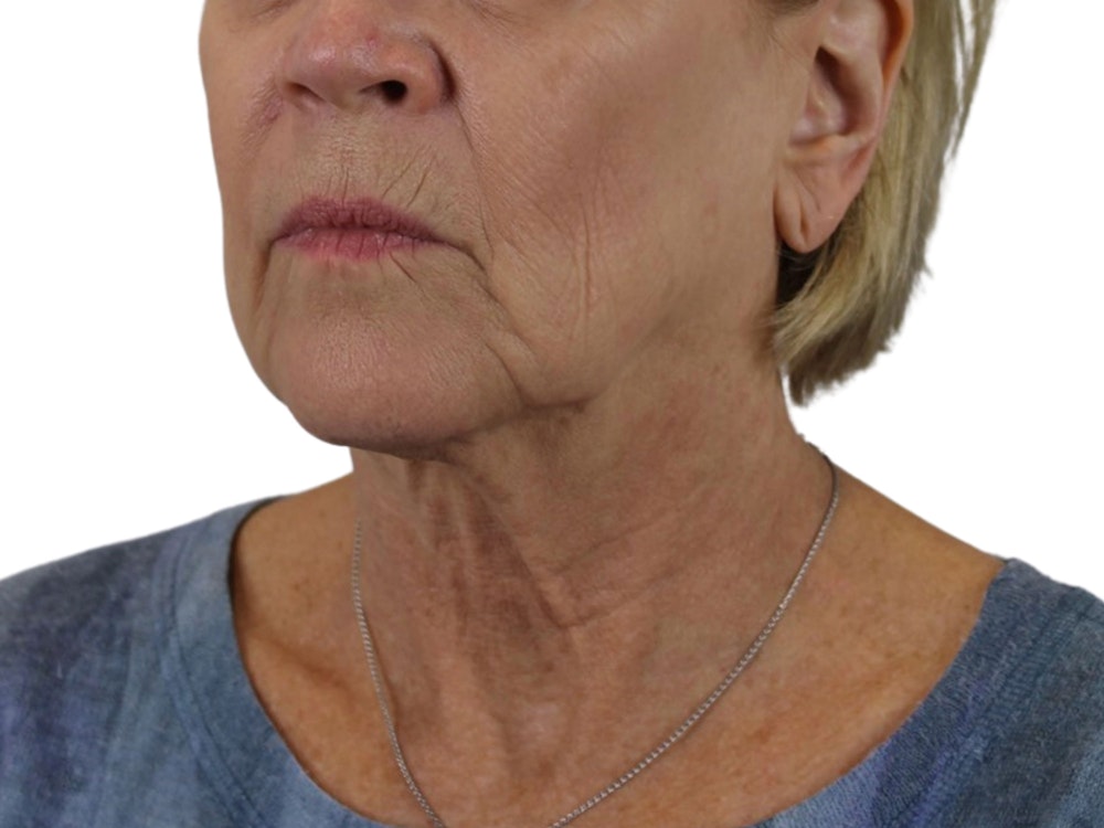Deep Neck Lift Before & After Gallery - Patient 118972217 - Image 7