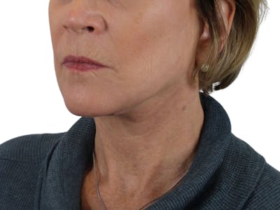 Deep Neck Lift Before & After Gallery - Patient 118972217 - Image 8