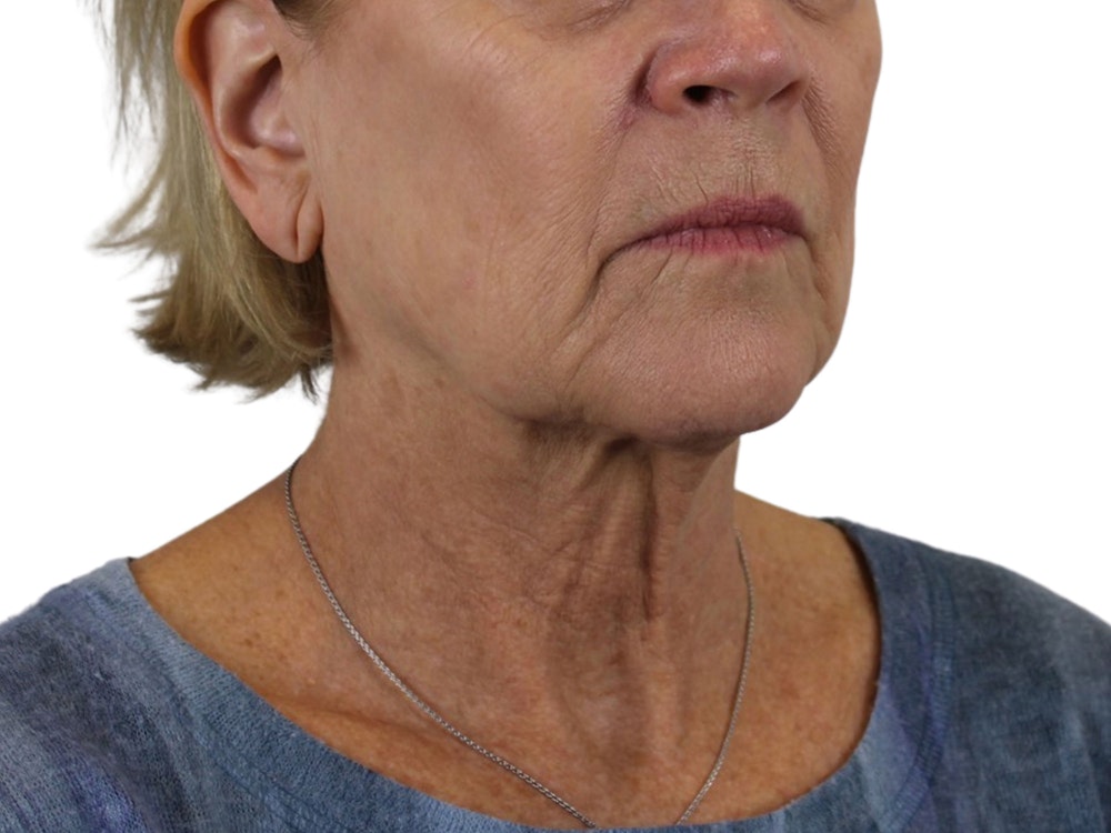 Deep Neck Lift Before & After Gallery - Patient 118972217 - Image 9