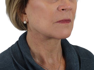 Deep Neck Lift Before & After Gallery - Patient 118972217 - Image 10