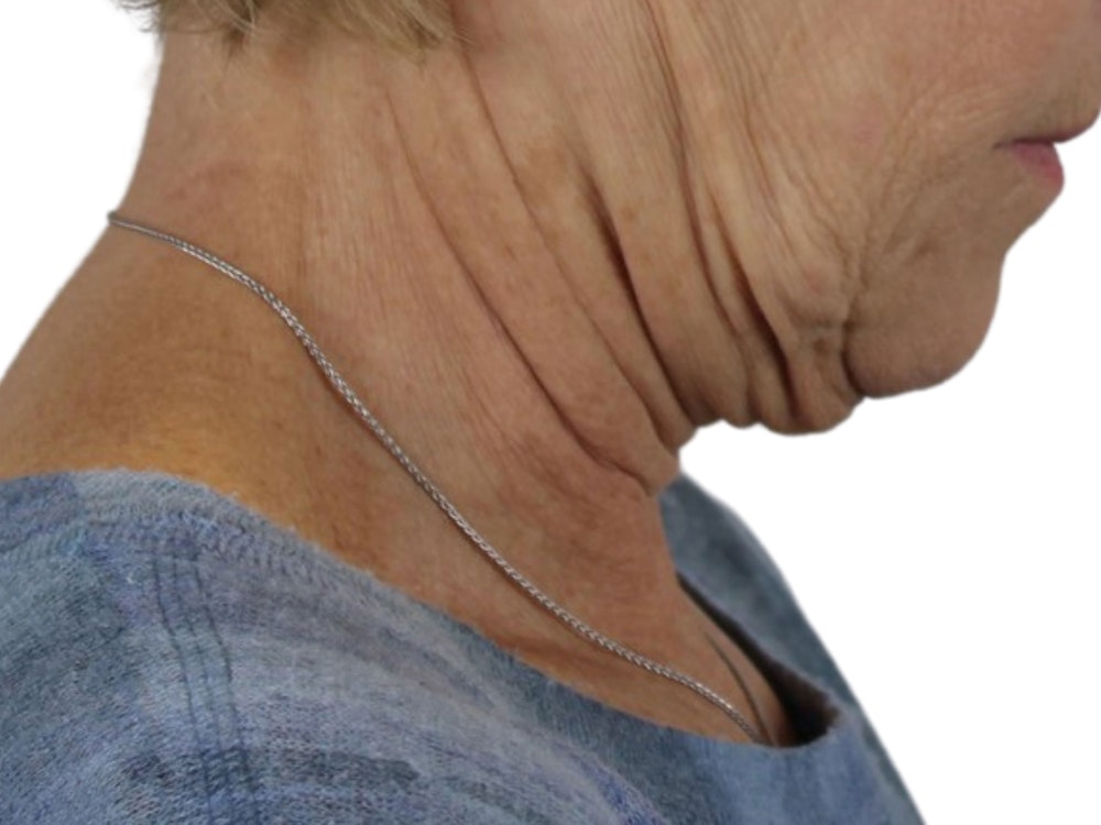 Deep Neck Lift Before & After Gallery - Patient 118972217 - Image 11