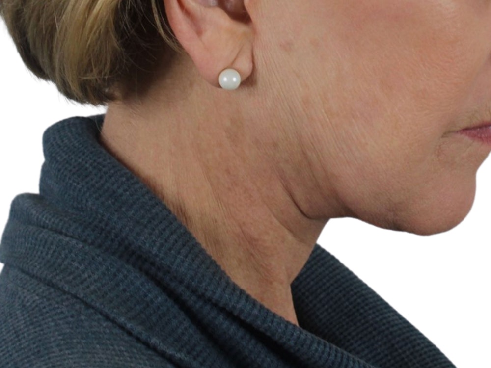 Deep Neck Lift Before & After Gallery - Patient 118972217 - Image 12