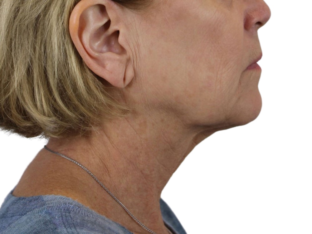 Deep Neck Lift Before & After Gallery - Patient 118972217 - Image 13