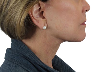 Deep Neck Lift Before & After Gallery - Patient 118972217 - Image 14