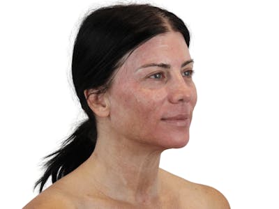 Sciton MOXI Before & After Gallery - Patient 166211763 - Image 1