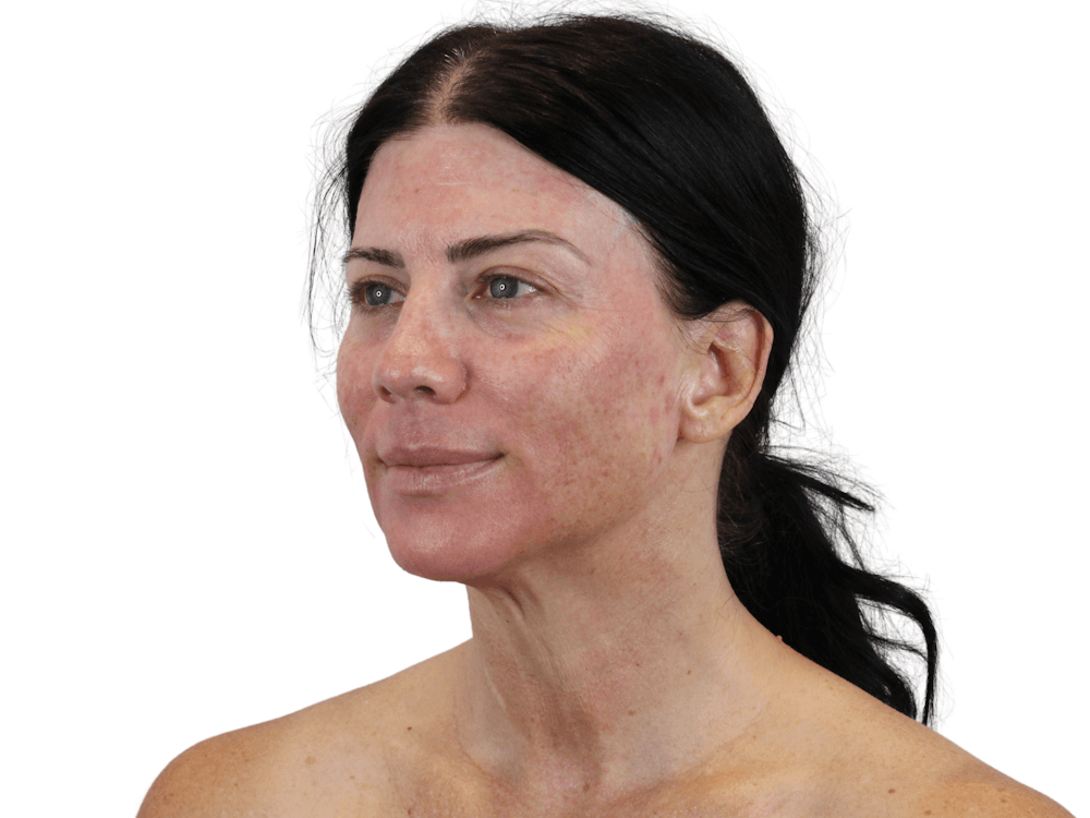 Sciton MOXI Before & After Gallery - Patient 166211763 - Image 3