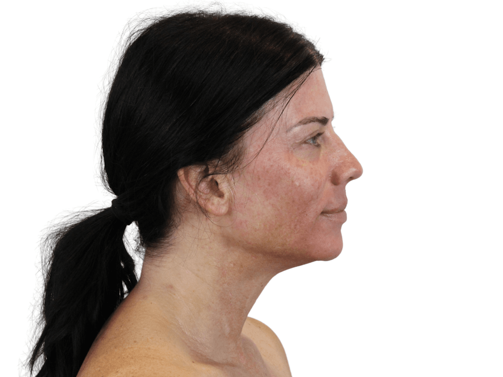 Sciton MOXI Before & After Gallery - Patient 166211763 - Image 7