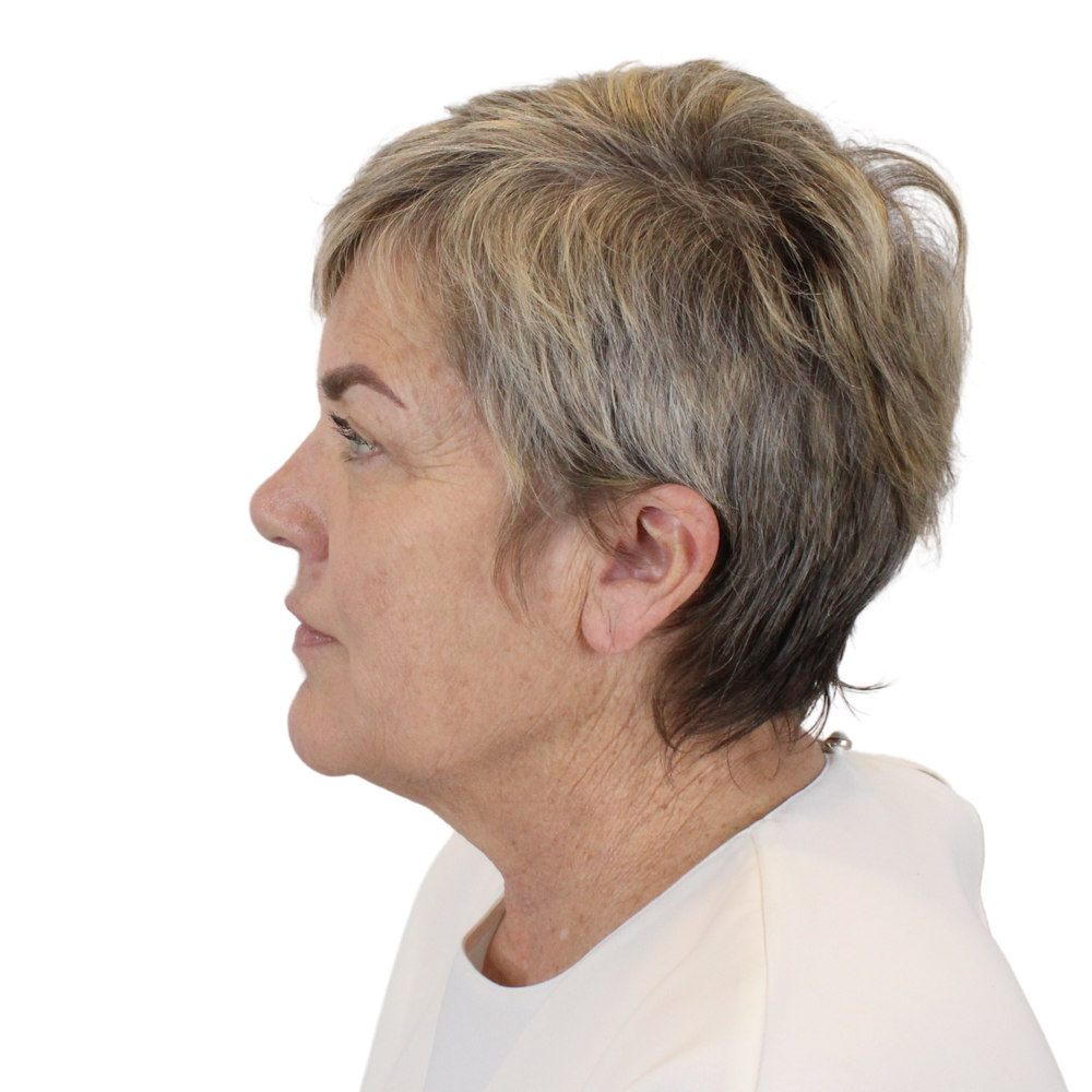 Deep Neck Lift Before & After Gallery - Patient 180003103 - Image 7