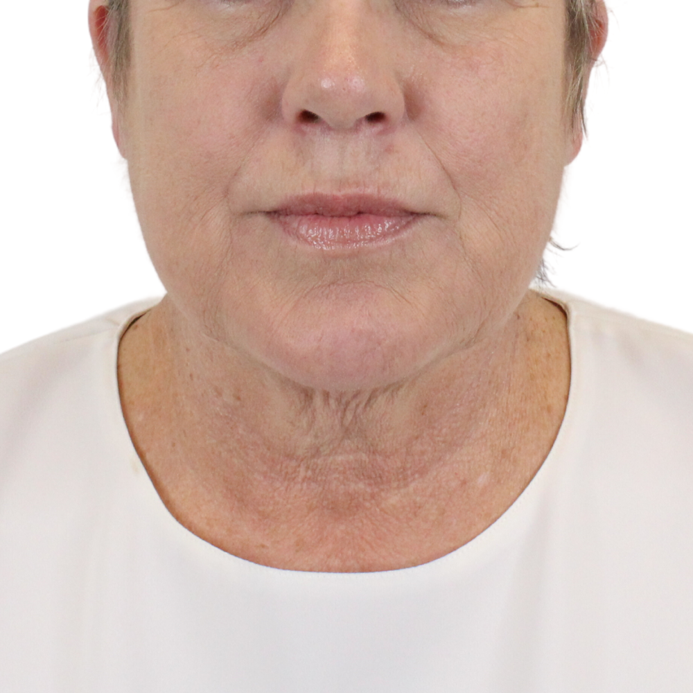 Deep Neck Lift Before & After Gallery - Patient 180003103 - Image 1