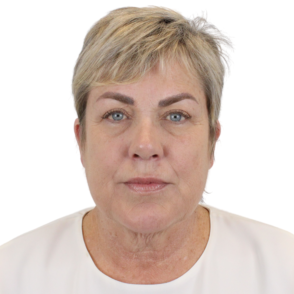 Deep Neck Lift Before & After Gallery - Patient 180003103 - Image 3