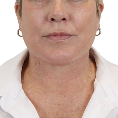 Deep Neck Lift Before & After Gallery - Patient 180003103 - Image 2