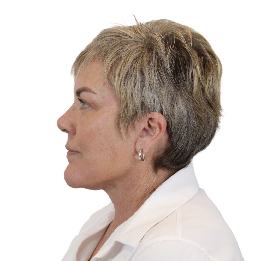 Deep Neck Lift Before & After Gallery - Patient 180003103 - Image 8