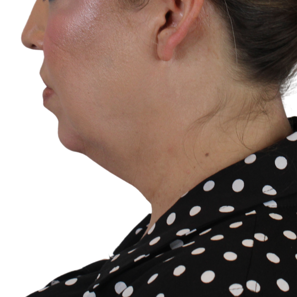 Deep Neck Lift Before & After Gallery - Patient 180003127 - Image 9