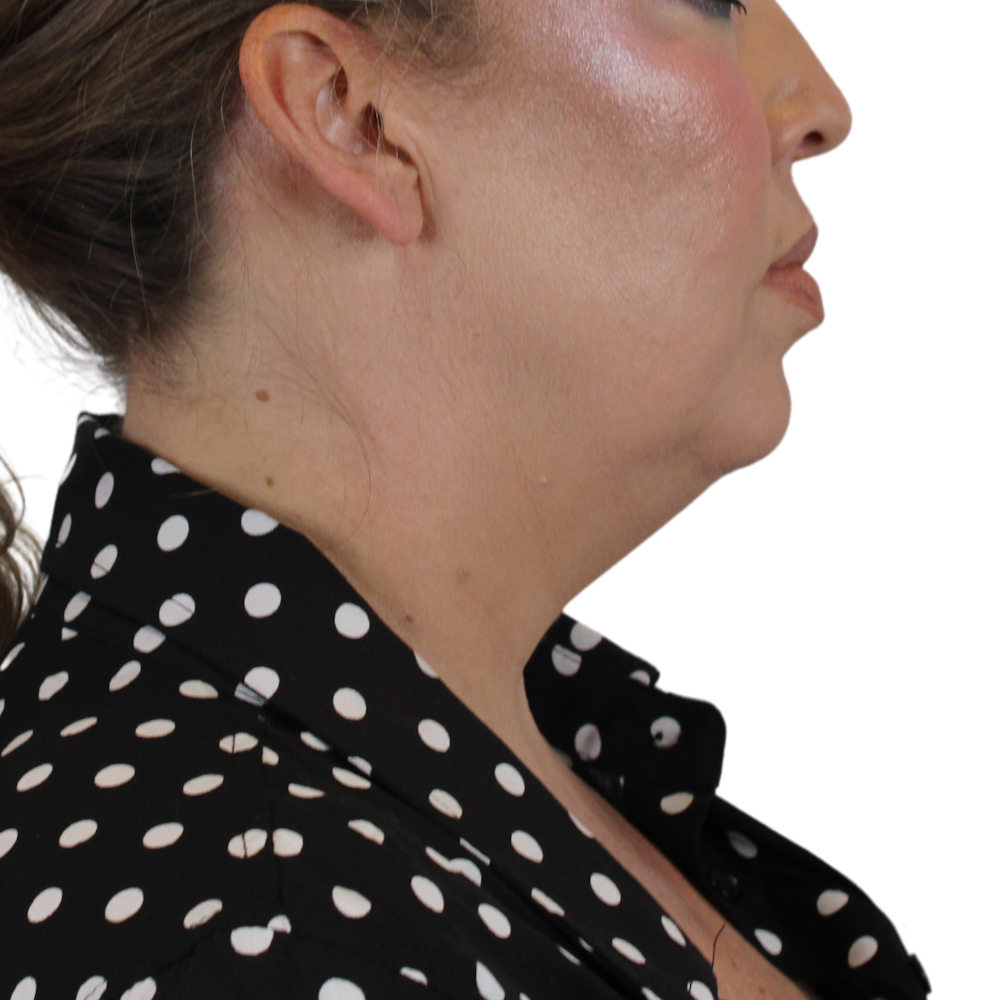 Deep Plane Facelift Before & After Gallery - Patient 180002360 - Image 7