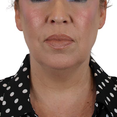 Deep Neck Lift Before & After Gallery - Patient 180003127 - Image 1