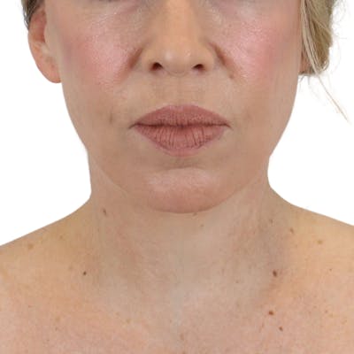 Deep Plane Facelift Before & After Gallery - Patient 180002360 - Image 2
