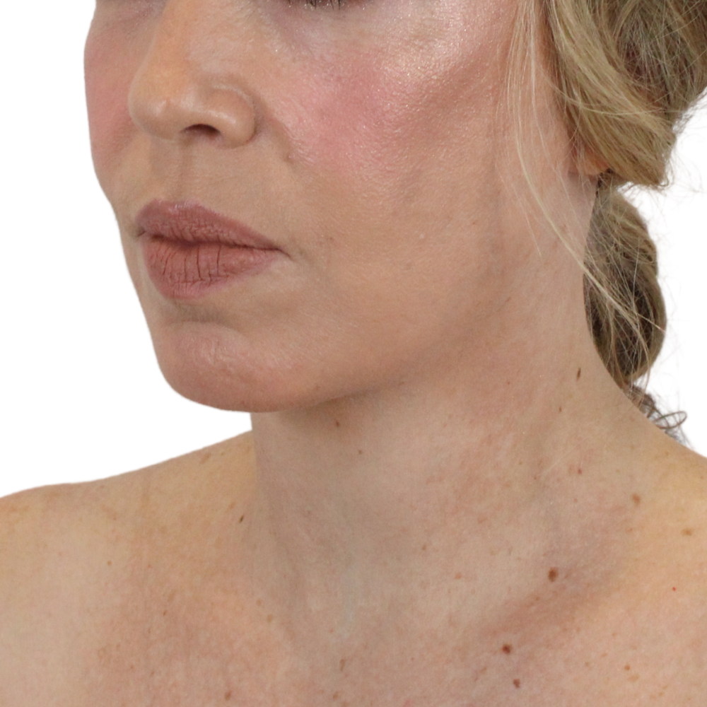 Deep Plane Facelift Before & After Gallery - Patient 180002360 - Image 6