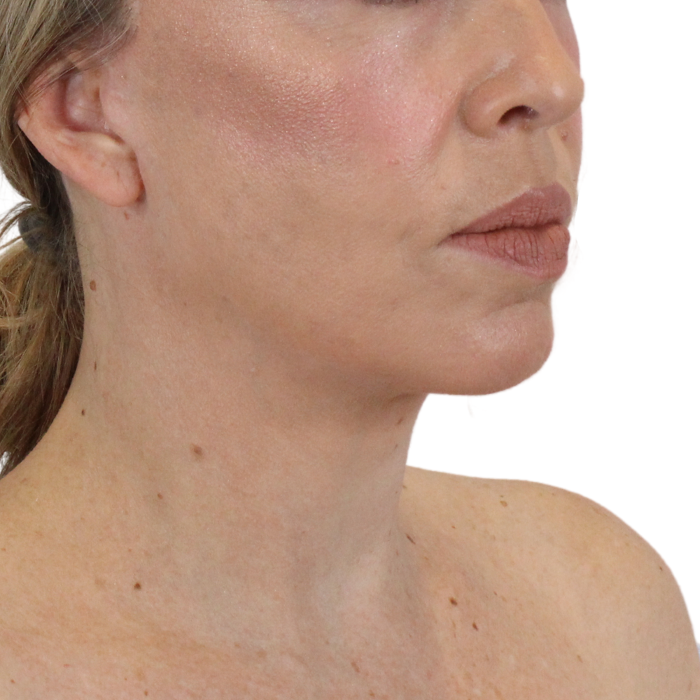 Deep Plane Facelift Before & After Gallery - Patient 180002360 - Image 4