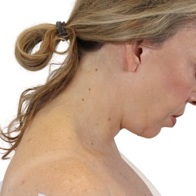 Deep Neck Lift Before & After Gallery - Patient 180003127 - Image 12