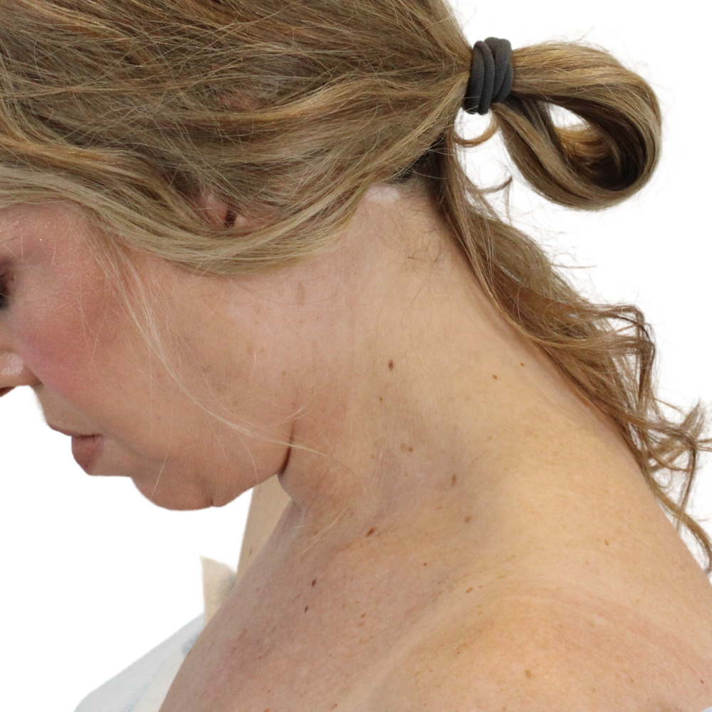 Deep Neck Lift Before & After Gallery - Patient 180003127 - Image 14