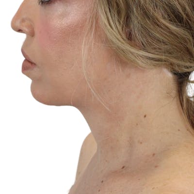 Deep Neck Lift Before & After Gallery - Patient 180003127 - Image 10