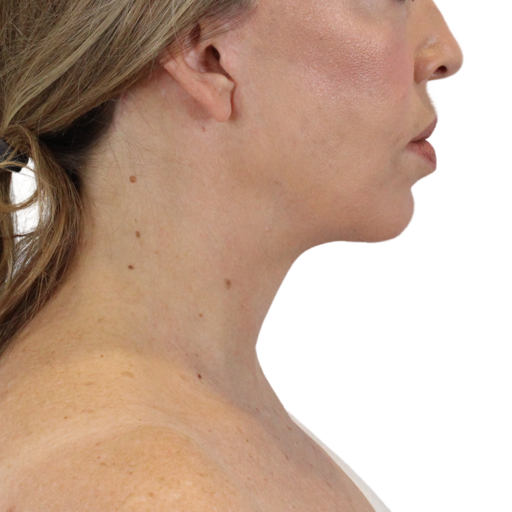 Deep Neck Lift Before & After Gallery - Patient 180003127 - Image 8