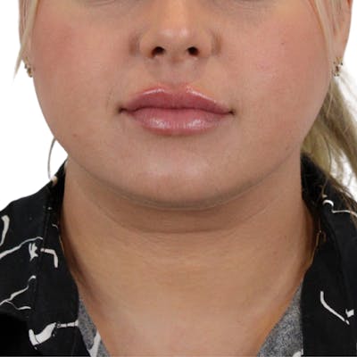 Lip Filler Before & After Gallery - Patient 180002520 - Image 2