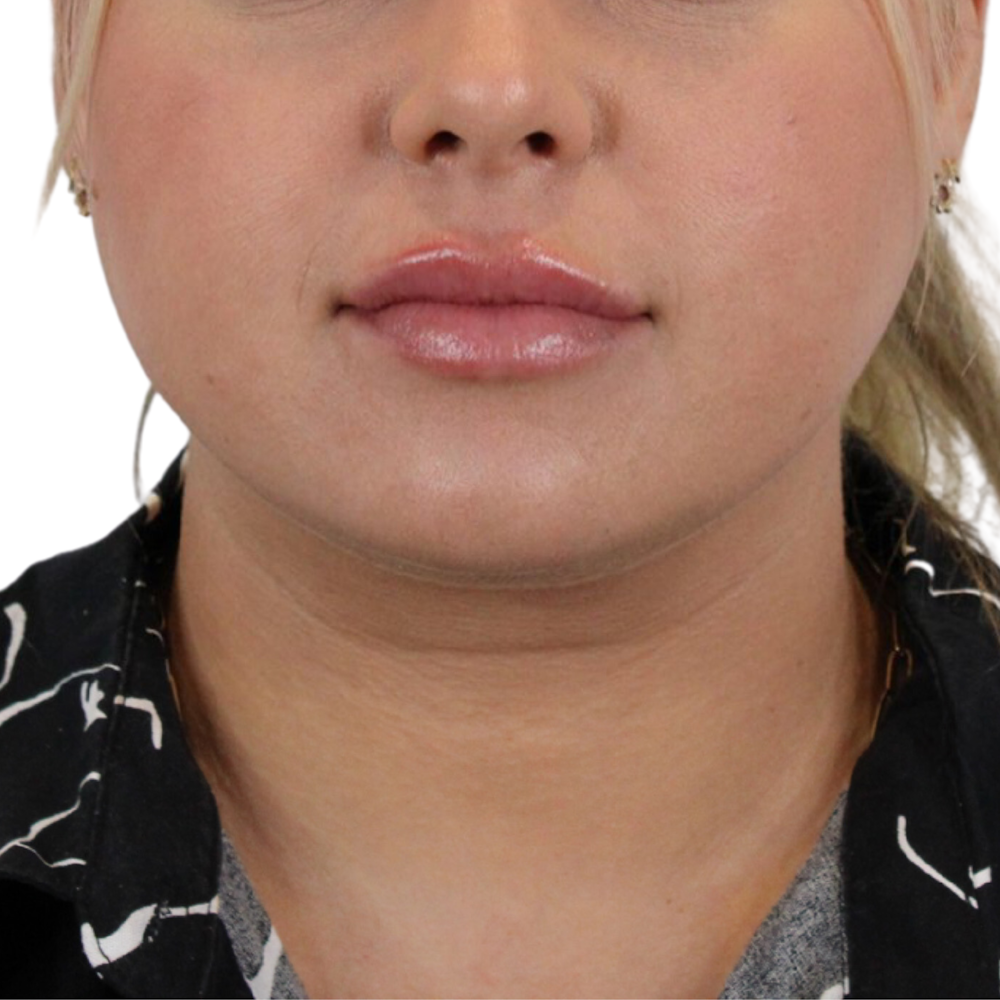 Lip Filler Before & After Gallery - Patient 180002520 - Image 2