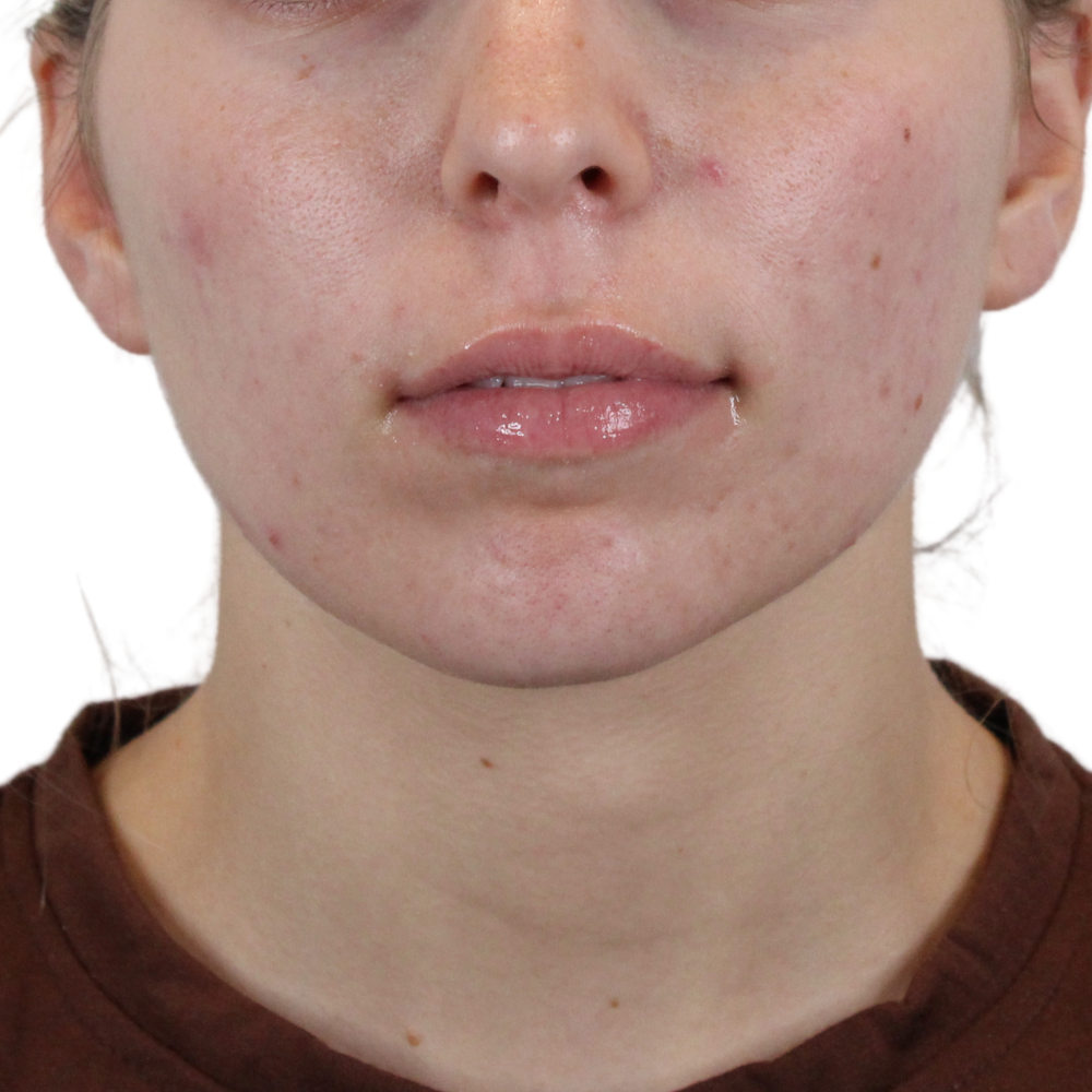 Lip Filler Before & After Gallery - Patient 180002524 - Image 1
