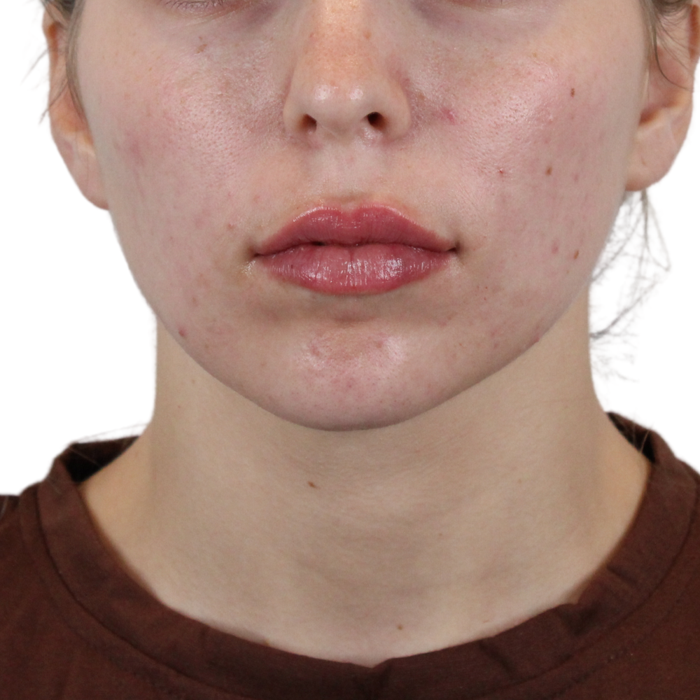 Lip Filler Before & After Gallery - Patient 180002524 - Image 2