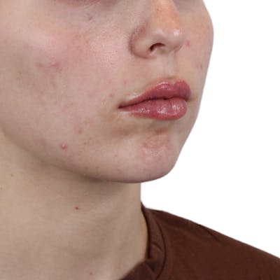 Lip Filler Before & After Gallery - Patient 180002524 - Image 4