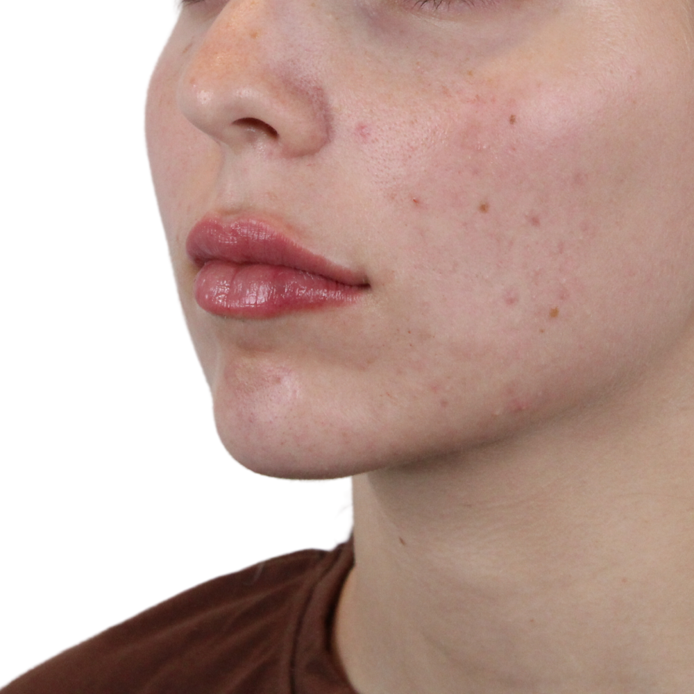 Lip Filler Before & After Gallery - Patient 180002524 - Image 6