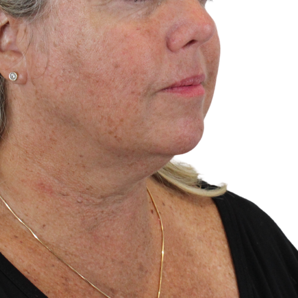 Chin Filler Before & After Gallery - Patient 180002565 - Image 3