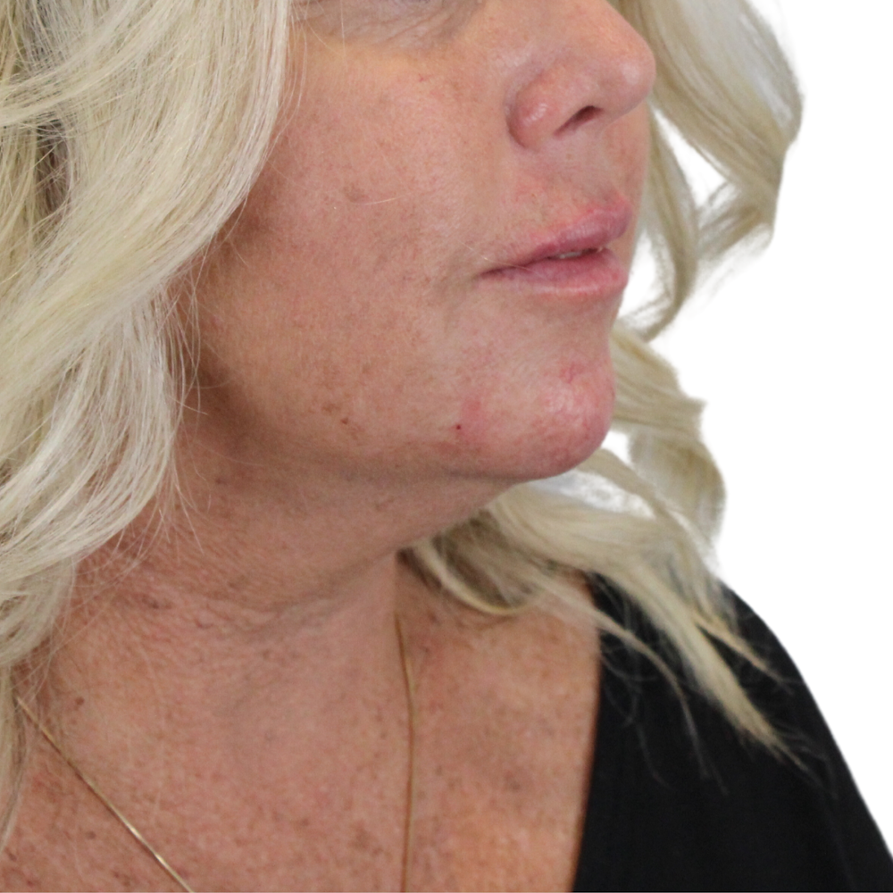 Lip Filler Before & After Gallery - Patient 180002527 - Image 4