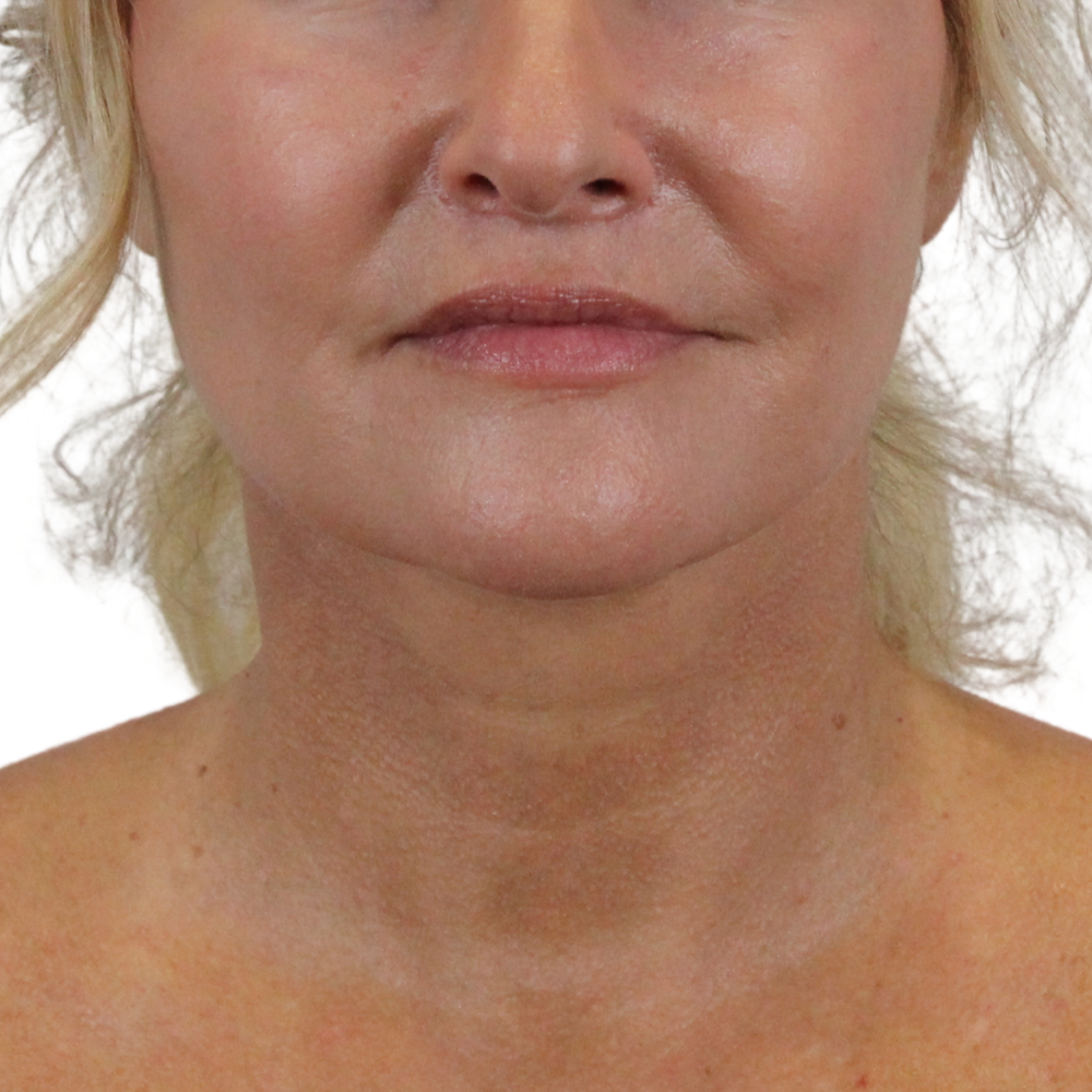 Lip Lift Before & After Gallery - Patient 998509 - Image 2