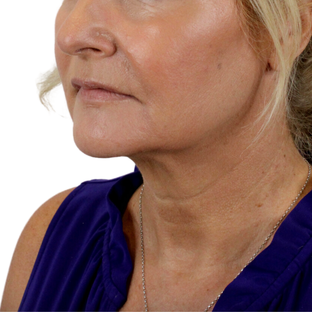 Lip Lift Before & After Gallery - Patient 998509 - Image 3