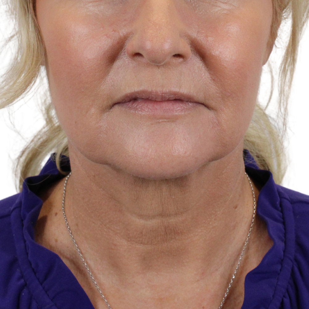 Lip Lift Before & After Gallery - Patient 998509 - Image 1