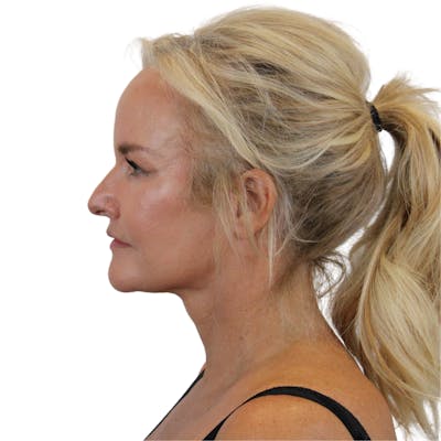Deep Neck Lift Before & After Gallery - Patient 244405 - Image 6